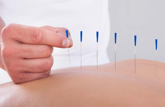 Soigner les allergies avec les aiguilles de l'acupuncture. La méthode naturelle la plus efficace pour retrouver un équilibre.