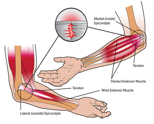 Soigner la tendinite interne du coude ( golf elbow ) : Exercices kiné 