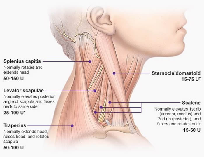 Torticolis