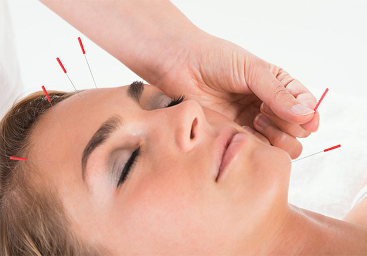 Lifting MTC du visage et acupuncture